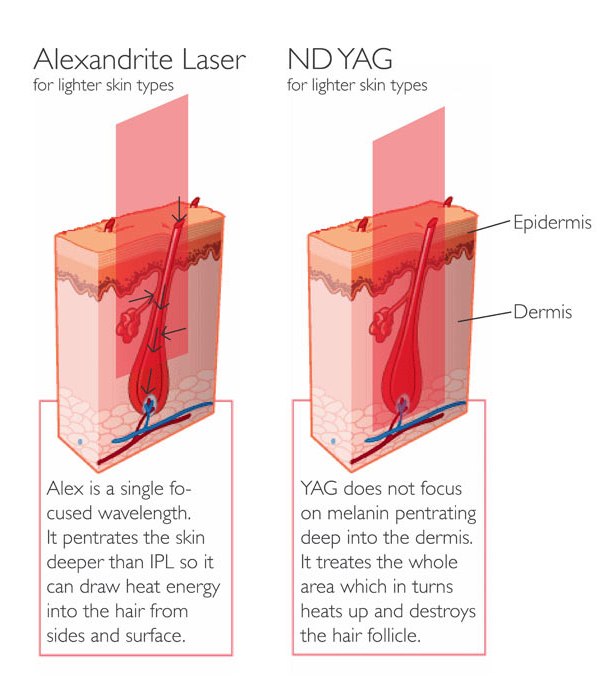 مقایسه لیزر الکساندرایت و ND:YAG
