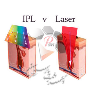 IPL یا لیزر، برای حذف موهای زائد کدام مناسب است؟