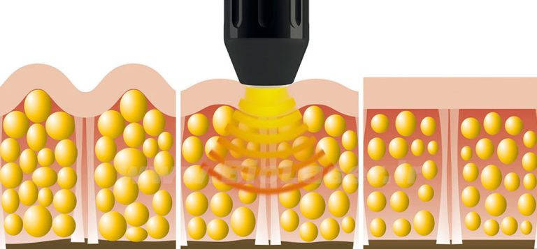 shockwave&cellulite