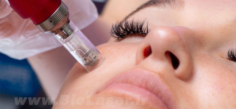 microneedling-biolaser.ir