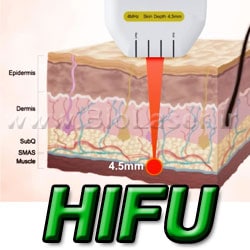 hifu treatment