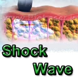 shock wave treatment